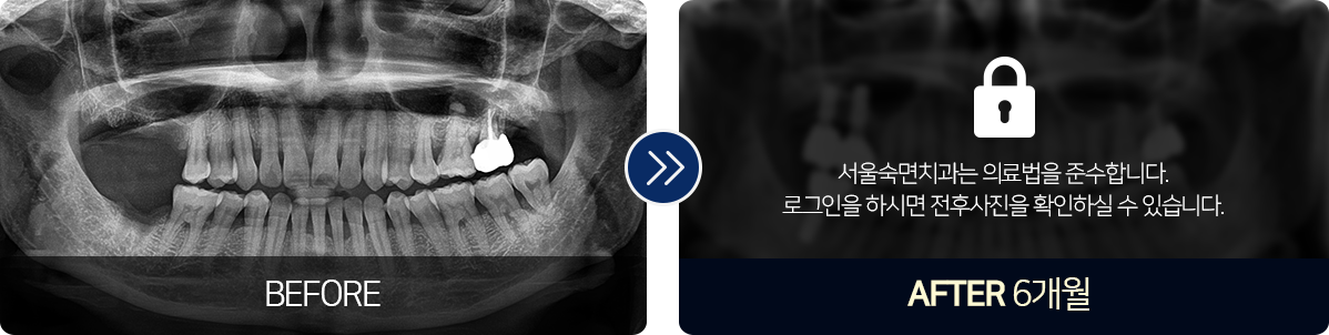 임플란트-전후사진1