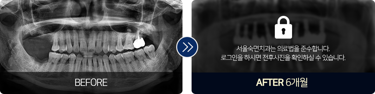 임플란트-전후사진2