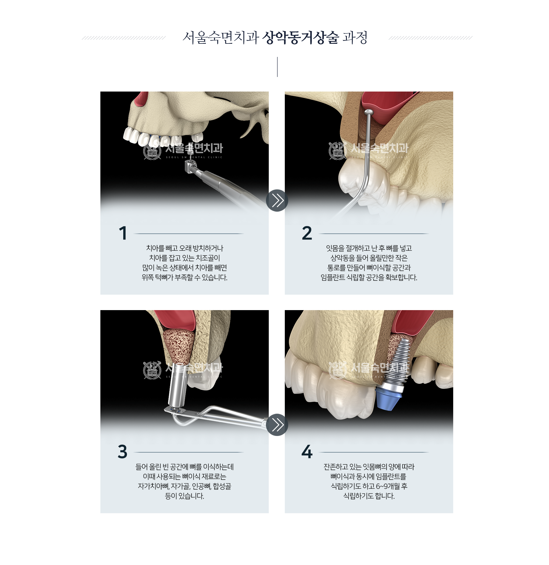상악동거상술-과정-1단계-치아를-빼고-오래-방치하거나-치아를-잡고-있는-치조골이-많이-녹은-상태에서-치아를-빼면-위쪽-턱뼈가-부족할-수-있습니다-2단계-잇몸을-절개하고-난-후-뼈를-넣고-상악동을-들어-올릴만한-작은-통로를-만들어-뼈이식할-공간과-임플란트-식립할-공간을-확보합니다-3단계-들어-올린-빈-공간에-뼈를-이식하는데-이때-사용되는-뼈이식-재료로는-자가-치아뼈-자가골-인공뼈-합성골-등이-있습니다-4단계-잔존하고-있는-잇몸뼈의-양에-따라-뼈이식과-동시에-임플란트를-식립하기도-하고-6~9개월-후-식립하기도-합니다