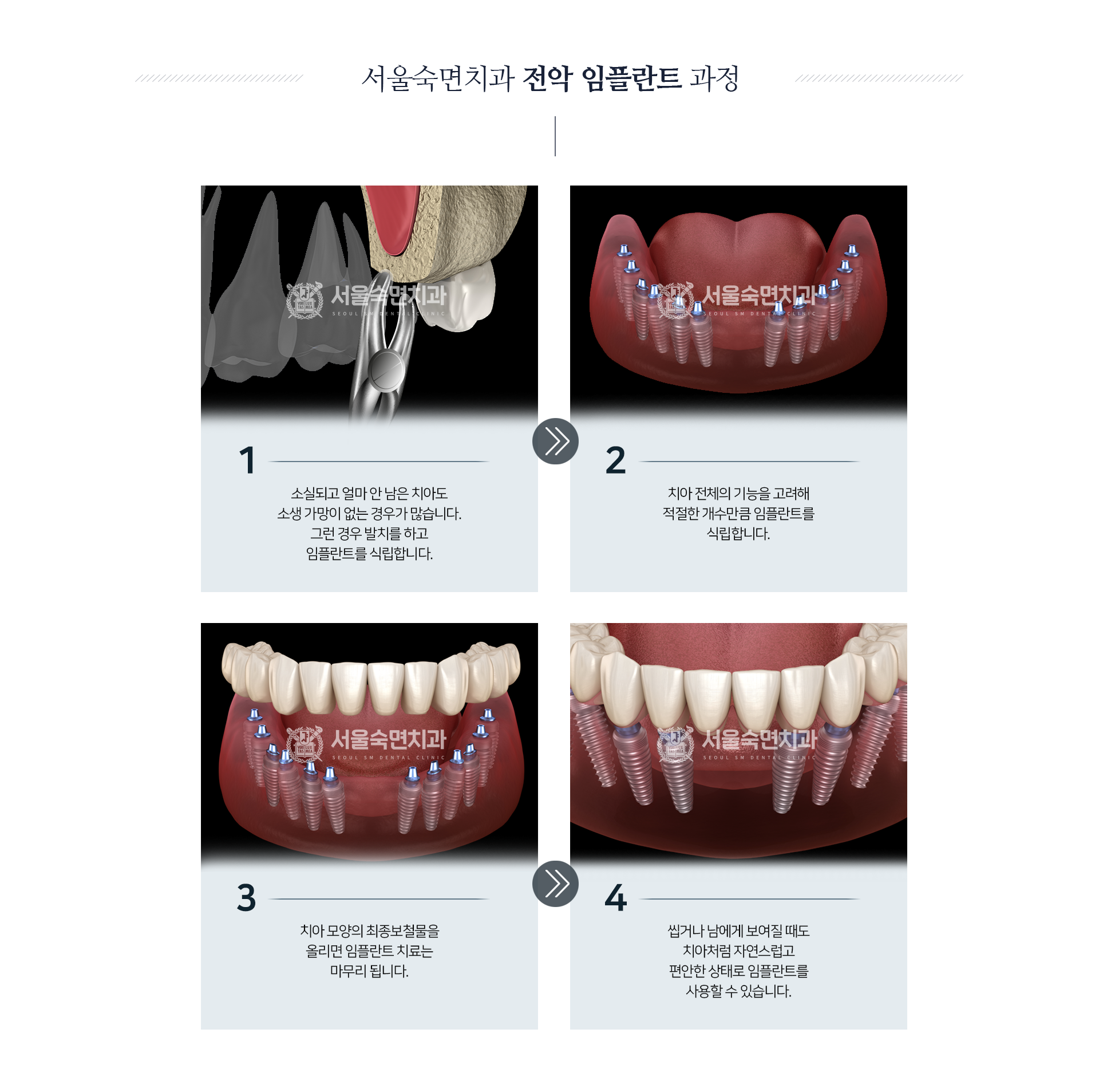 전악-임플란트-과정-1단계-소실되고-얼마-안-남은-치아도-소생-가망이-없는-경우가-많습니다-그런-경우-발치를-하고-임플란트를-식립합니다-2단계-치아-전체의-기능을-고려해-절절한-개수만큼-임플란트를-식립합니다-3단계-치아-모양의-최종-보철물을-올리면-임플란트-치료는-마무리됩니다-4단계-씹거나-남에게-보여질-때도-치아처럼-자연스럽고-편안한-상태로-임플란트를-사용할-수-있습니다