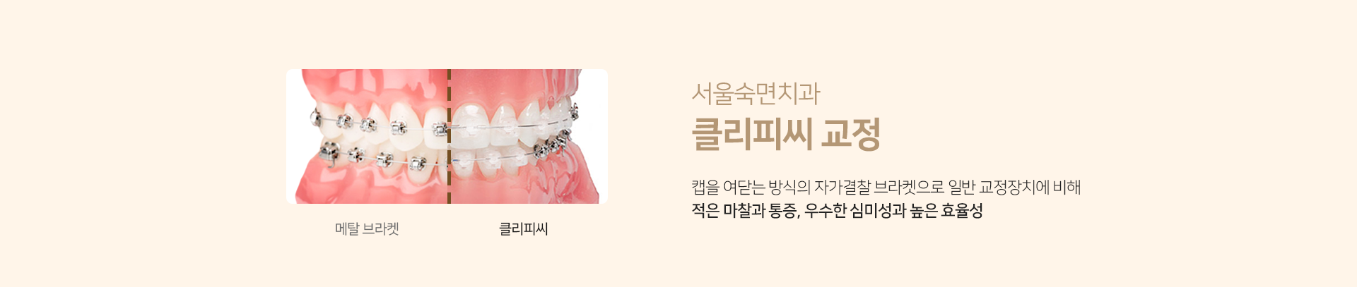 클리피씨-교정-캡을-여닫는-방식의-자가결찰-브라켓으로-일반-교정장치에-비해-적은-마찰과-통증-우수한-심미성과-높은-효율성
