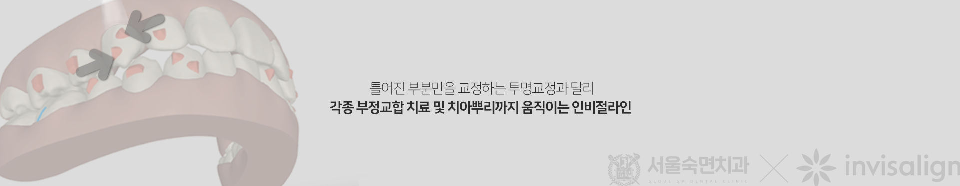 틀어진-부분만을-교정하는-투명교정과-달리-각종-부정교합-치료-및-치아-뿌리까지-움직이는-인비절라인